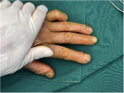 The first case report of an intraosseous epidermoid cyst in the distal phalanx of the index finger with infection resulting in single clubbing finger: A case report and review of the literature